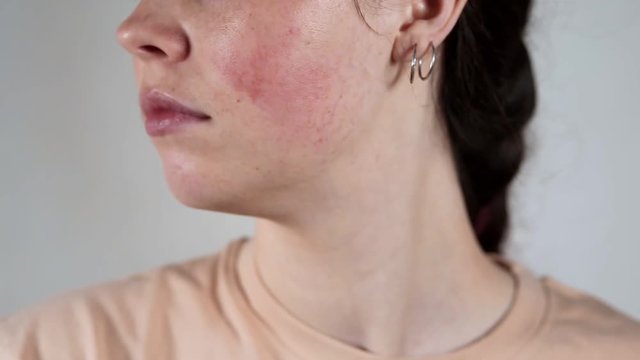 What Skin Concern Can Facial Capillaries Treatment Treat?