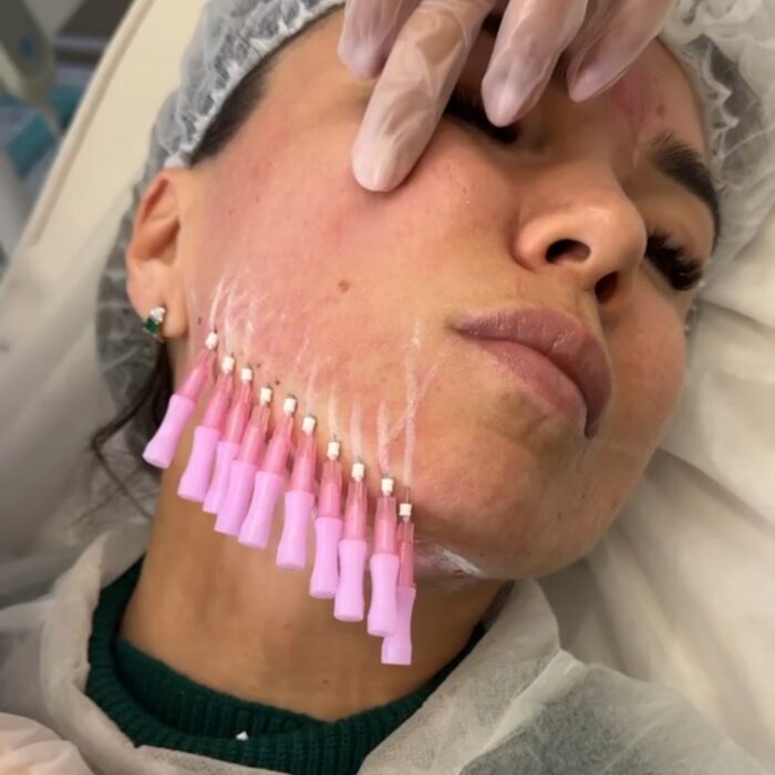 Are PDO Mono Threads Good for Skin Tightening Without Surgery?