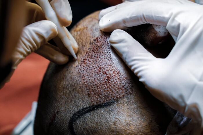 Can FUSS Hair Transplant Restore Completely Bald Areas?