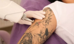 Can Laser Tattoo Removal Improve Skin After Tattoo Fading?