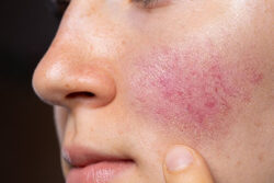Does Facial Capillary Treatment Suit Sensitive Skin Care?