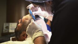 Does Hair Transplant Cost Depend on Hair Loss Severity?