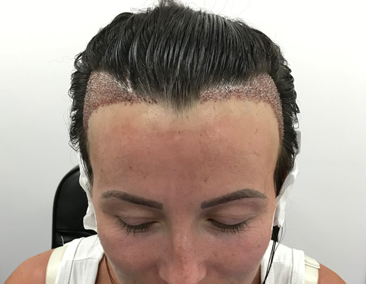 Does Hair Transplant Leave Minimal Scarring After Procedure?