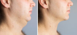 Is Kybella Treatment For Double Chin the secret jawline boost?