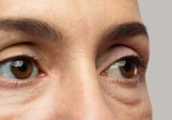 Eye Bag Removal: Understanding Puffiness Triggers