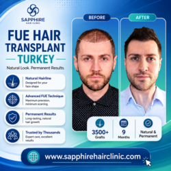 FUE Hair Transplant Turkey vs Other Countries: What Makes Turkey Stand Out?