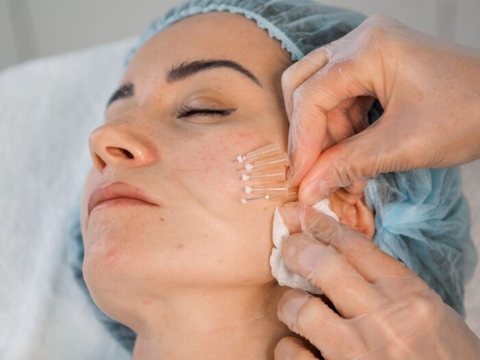 How Do PDO Mono Threads Stimulate Collagen Production?