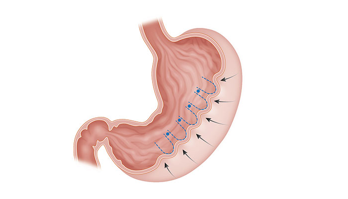 How Does Gastric Plication Reduce Stomach Size Naturally?
