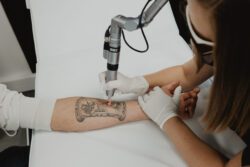 How does laser tattoo removal work for stubborn ink layers?