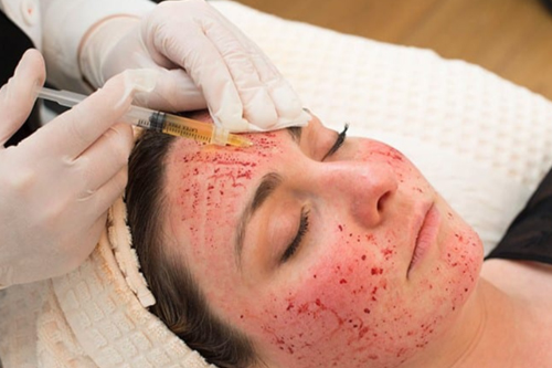 Does Vampire Facial Stimulate Natural Collagen Production?