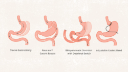 How Long Does It Take to Lose Weight After Gastric Bypass?