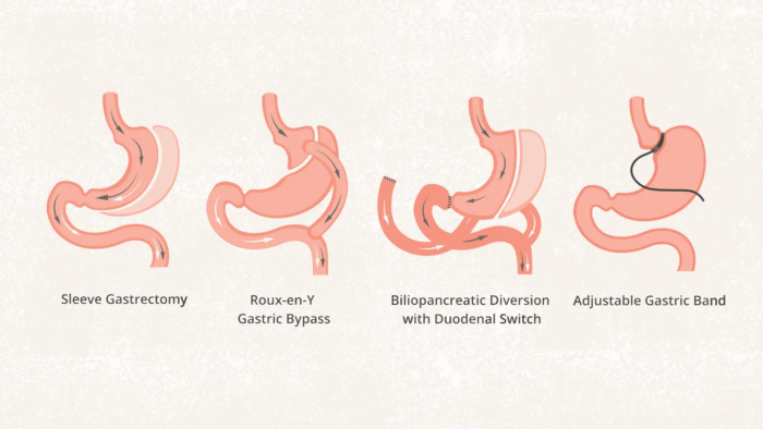 How Long Does It Take to Lose Weight After Gastric Bypass?