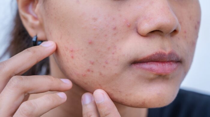 Is Pimples Treatment Suitable for Cystic Acne?