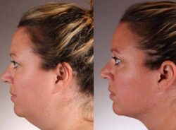 Addressing the Hormonal Impact on Skin Thickness During Menopause