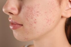 What Are Gentle Treatments for Sensitive Pimples?