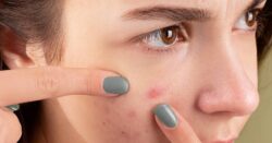 What Helps Reduce Pimples and Acne Breakouts Fast?