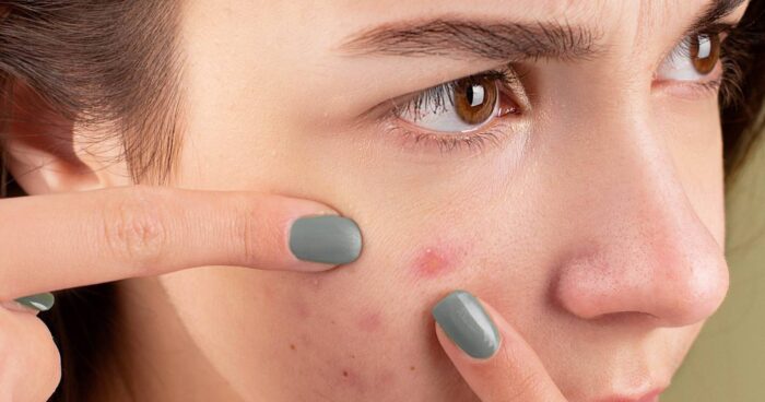 What Helps Reduce Pimples and Acne Breakouts Fast?