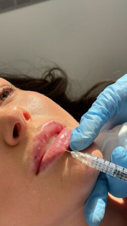 Why Do People Get Lip Filler Injections for First Time?