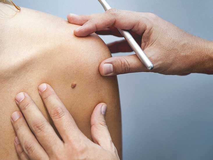 How Do Dermatologists Remove Stubborn Moles?