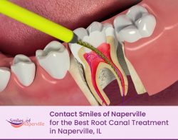 Contact Smiles of Naperville for the Best Root Canal Treatment in Naperville, IL