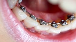 WHAT ARE INCOGNITO BRACES? HOW EFFECTIVE ARE THEY?