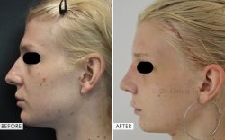Facial Feminization Surgery Results | Before and After Photos