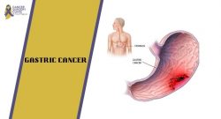 Famous Doctor For Gastric Cancer Treatments