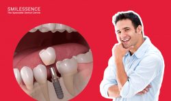 Best Dental Implants By Smilessence