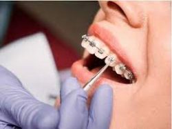 Expert Orthodontist in Miami – Orthodontists Specialists Of Florida