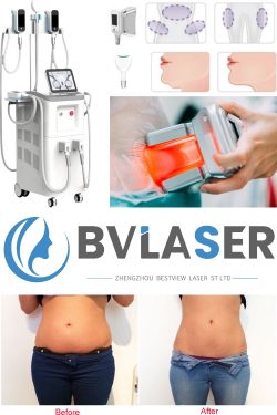 Questions about Cryolipolysis fat loss