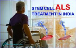Stem Cell ALS Treatment In India