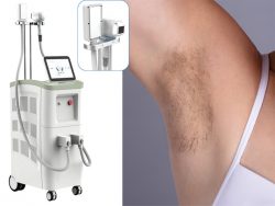 Best affordable laser hair removal device