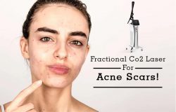 The best CO2 fractional laser machine for skin