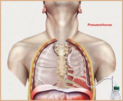 Pneumothorax (Collapsed Lung) Symptoms, Causes and Surgical Treatment in Delhi, India