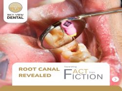 Root Canal Treatment in Noblesville | Skyview Dental