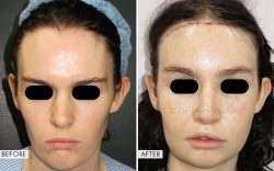 Facial Feminization Surgery Results