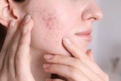 Acne: Understanding, Managing, and Overcoming Its Effects