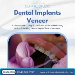 Perfect Smile with Dental Implants & Veneers