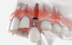 Dental Implants Penrith