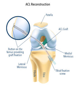 Trusted Care for Your ACL Reconstruction Surgery