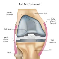 Expert Care for Your Knee Replacement in Melbourne