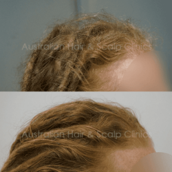 Personalised Hair Loss Solutions in Sydney