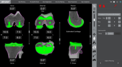 How Can Robotic Partial Knee Replacement Surgery Benefit You?