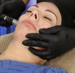 Microneedling Paddington