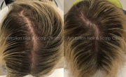 Regrow Hair Naturally with Herbal Treatments