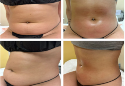 Why Double Chin Removal Is the Secret to a Sculpted Jawline