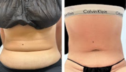 How to Get a Lifted, Toned Look with Vacuum Butt Lift Technology