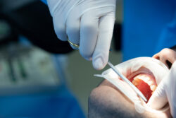 How to Prepare for a Surgical Extraction Of Tooth?