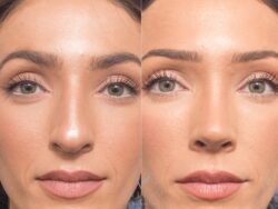 Unlock Flawless Silhouette Gracefully with Rhinoplasty