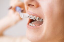 How to Manage Discomfort From Dental Braces